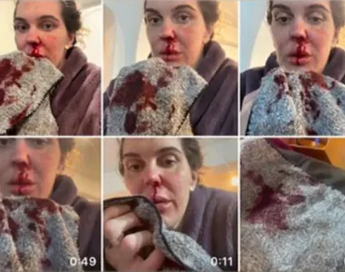Gabi Garcia mostra imagens com o nariz sangrando