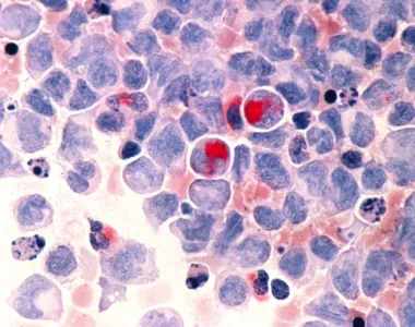 SUS estuda adoção de tratamento promissor contra câncer