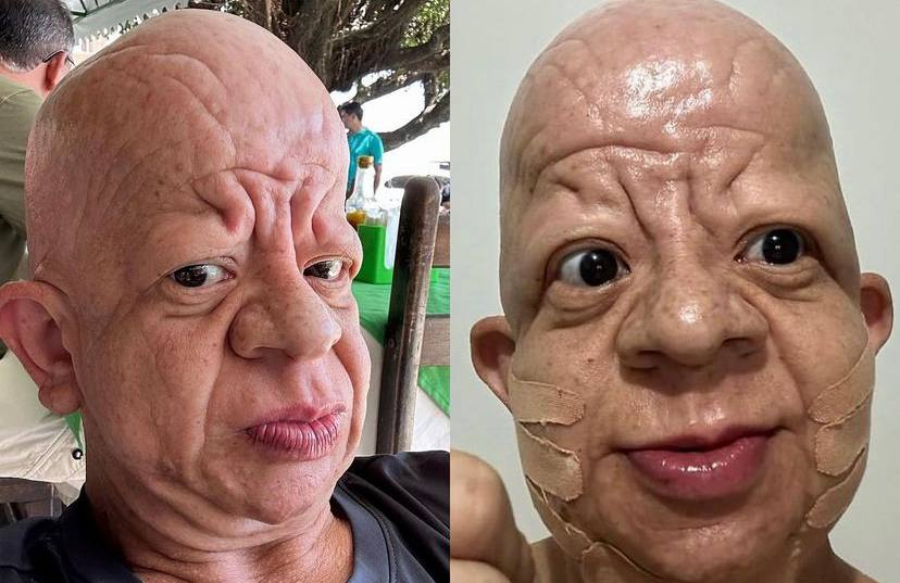 IInfluencer Bruno Diferente faz harmonização facial; veja resultado