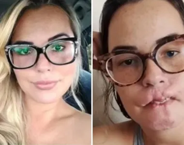 A profissional aplicou um produto proibido para esse tipo de técnica nos lábios da mulher