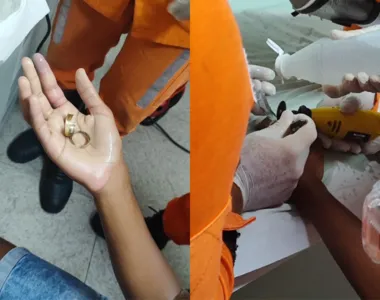 Bombeiros de Camaçari realizam resgate de anel preso no dedo de adolescente em Camaçari