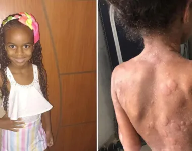 Ágatha Louise tem apenas 7 anos e sofre com Dermatite grave
