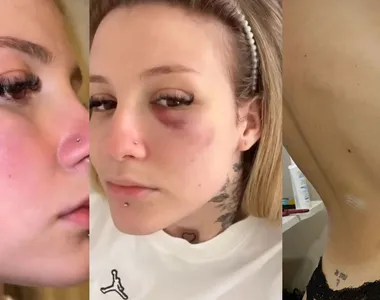 Clara Monteiro revelou ter sofrido agressões e mostrou hematomas