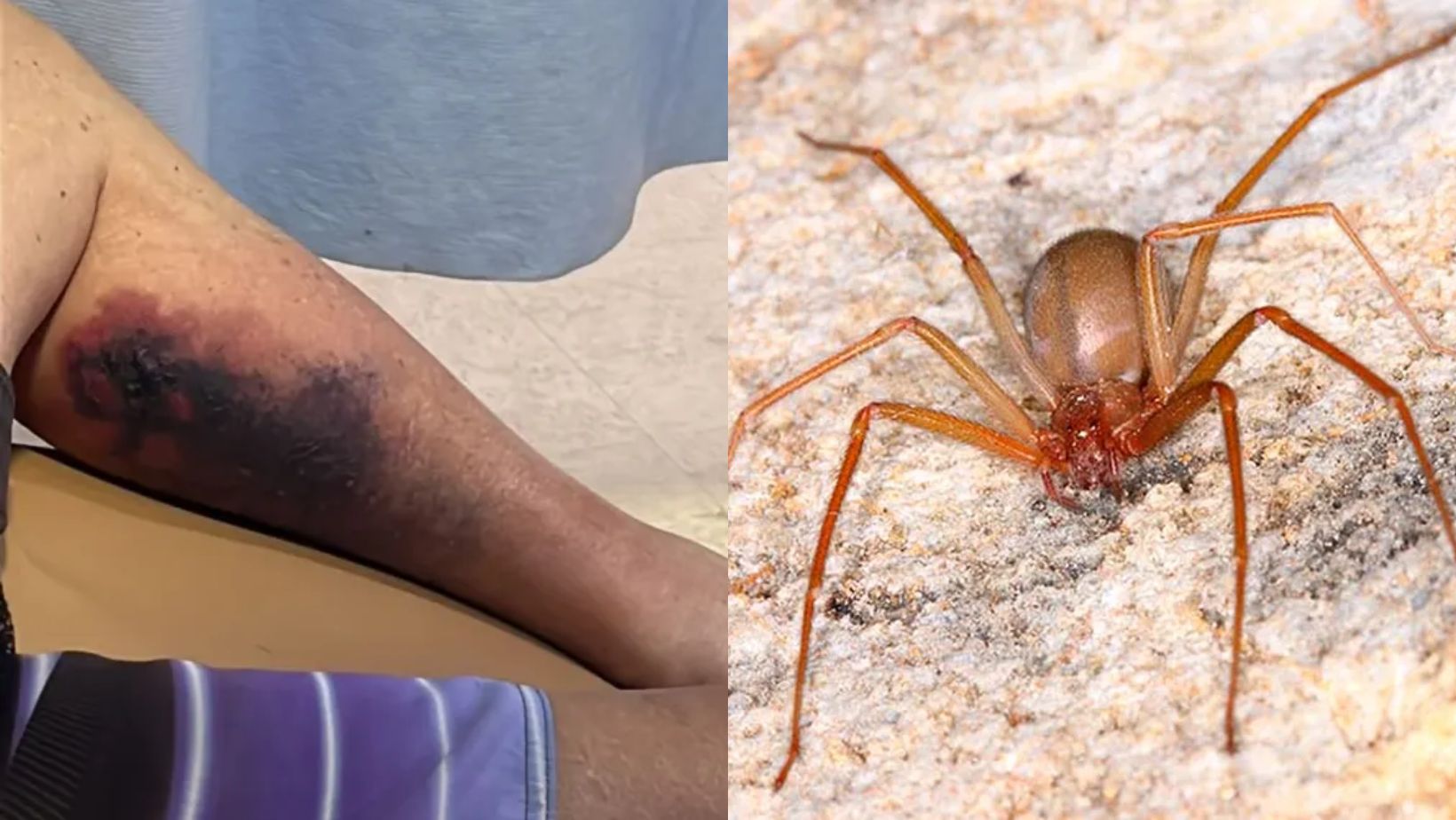 Vítima foi atacada por uma aranha-marrom