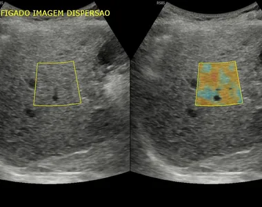 Exame mostra grau de esteatose hepática