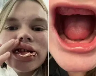 Alana Boone perdeu todos os dentes naturais