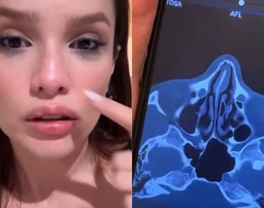 Juliette sofreu uma microfratura no nariz