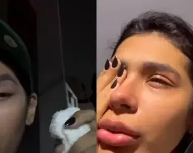 Cantora machucou o olho