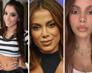 Anitta já realizou diversas cirurgias plásticas