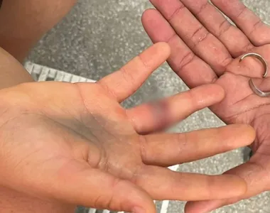 Anel ficou preso devido a um inchaço