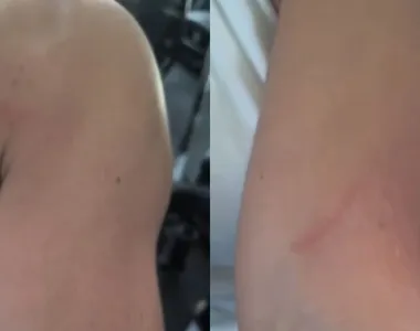 Vídeo mostra marcas vermelhas no braço e no ombro esquerdo da mulher