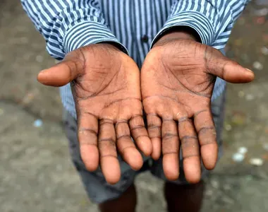 Trabalhador mostra as mãos