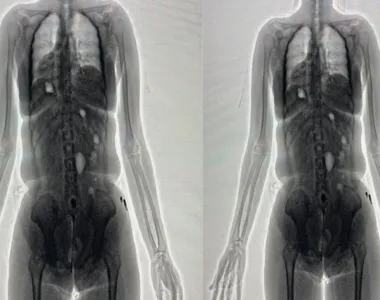 Flagrante aconteceu após o BodyScan identificar um corpo estranho