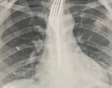 Exames mostraram objetio no corpo da mulher