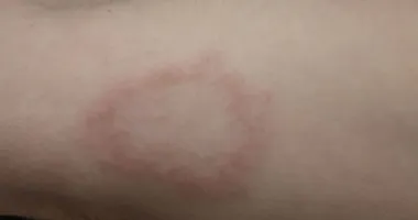 Imagem ilustrativa da imagem Clínica abre vagas para estudo sobre a hanseníase