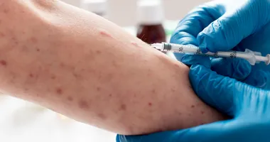 Imagem ilustrativa da imagem Mpox em Salvador: homem pode ter sido infectado em São Paulo