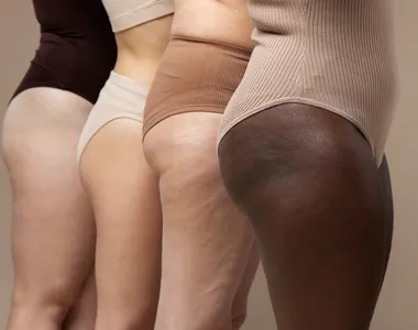 Coxas e glúteos são as áreas mais afetadas