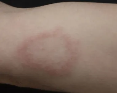 Marca da hanseníase