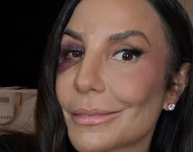 Ivete tomou uma queda e precisou ser hospitalizada