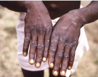 Mpox apresenta alguns sintomas, inclusive lesões na pele