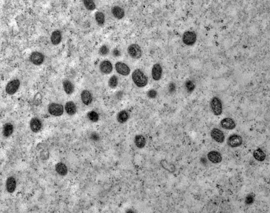 Entendimento da Mpox ainda é um dilema