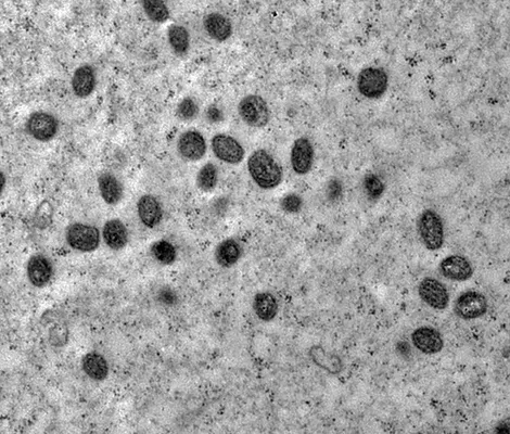 Imagem ilustrativa da imagem Dois casos de Mpox são registrados na Bahia; saiba os sintomas