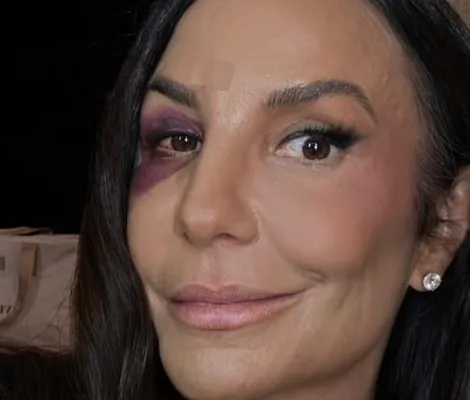 Imagem ilustrativa da imagem Ivete Sangalo passa por nova cirurgia e amigo tranquiliza fãs