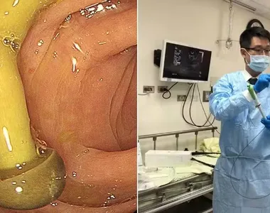 Médico alertou para a importância da mastigação