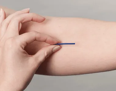 Implante contraceptivo é inserido no braço