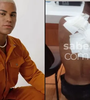 Imagem ilustrativa da imagem Queimado e agredido: influenciador baiano sofre violência após assalto