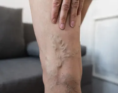 Varizes representam um problema para além da estética