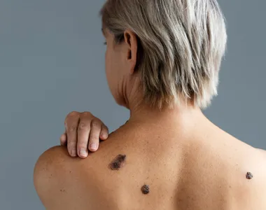 É importante visitar o dermatologista periodicamente