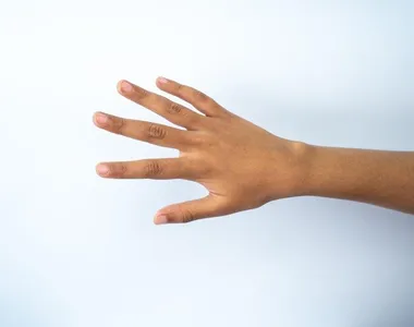 Jovem perdeu seis dedos das mãos