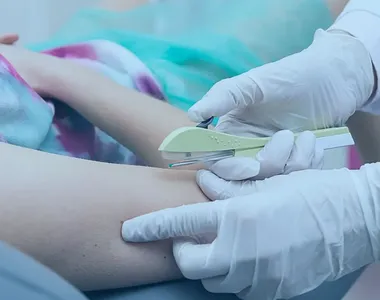 Contraceptivo é aplicado logo abaixo da pele