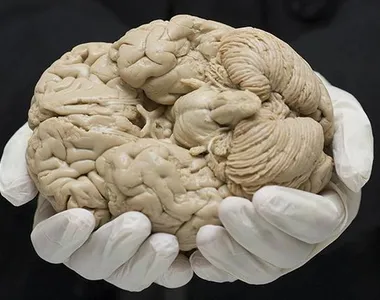 Custo mensal para frear o Alzheimer fica acima de R$ 11 mil