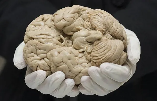 Imagem ilustrativa da imagem Medicamento que promete retardar Alzheimer chega ao Brasil em junho