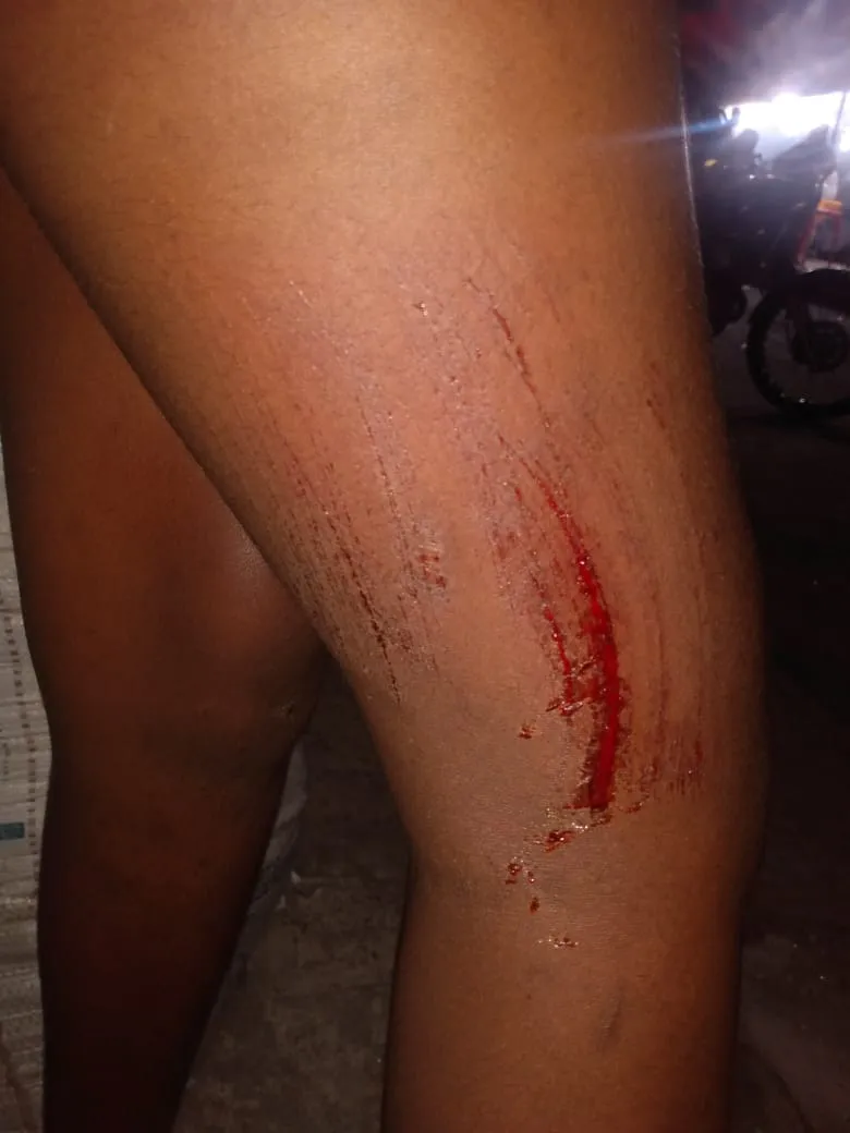 O arranhão causado na perna de Anna Luyza após a queda