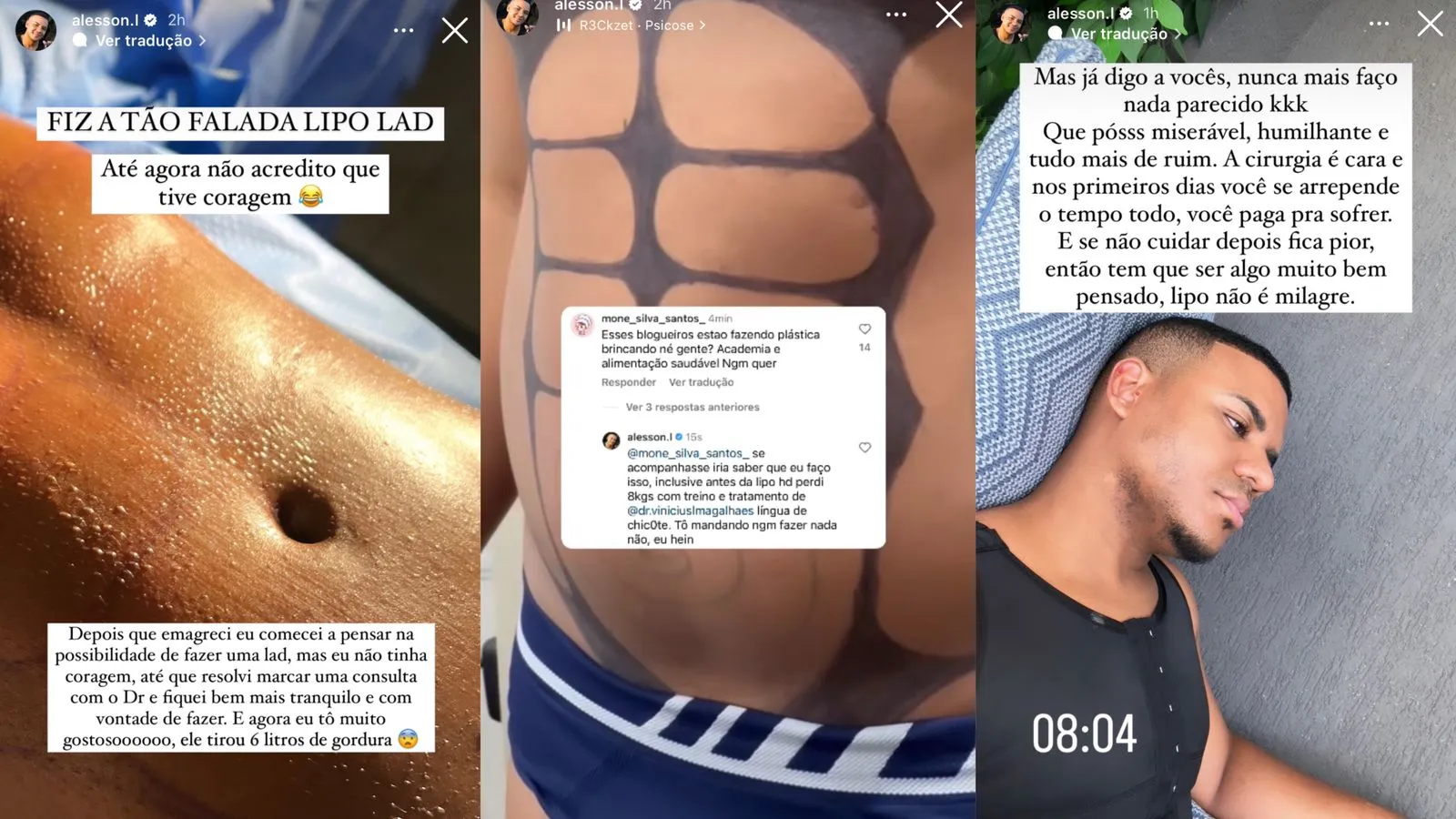 Influenciador digital compartilhou detalhes da cirurgia com os seguidores