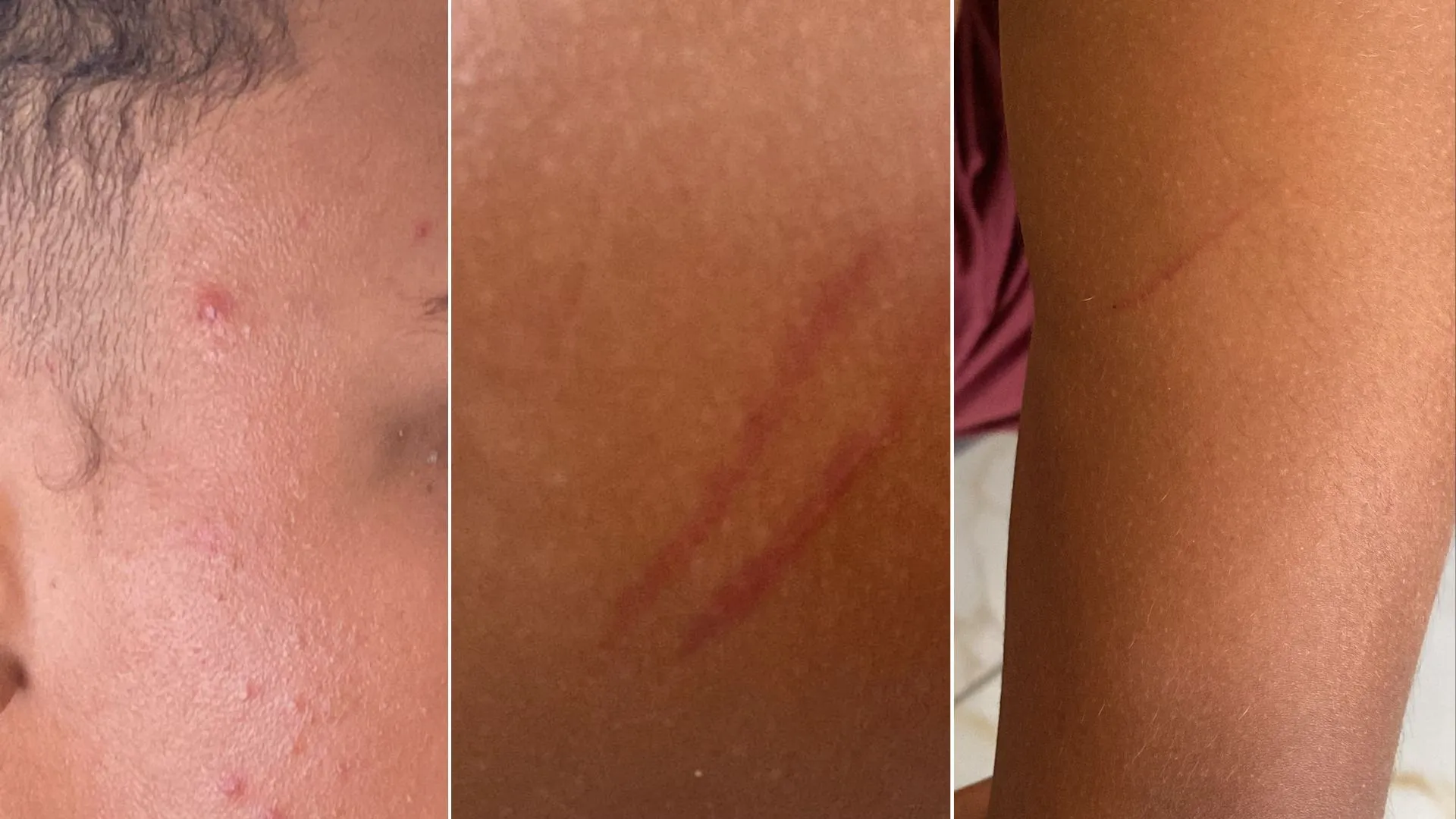 Eric Mário enviou fotos dos hematomas após a briga