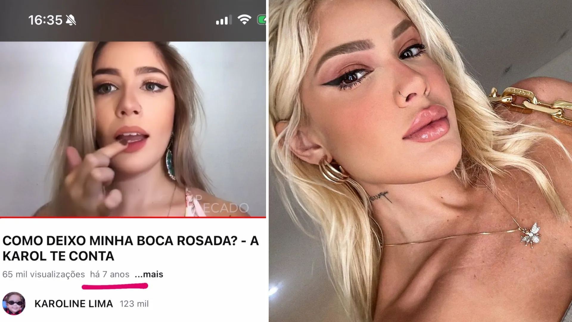 Imagem ilustrativa da imagem Outra mulher! Veja fotos de Karoline Lima antes de 'dar grau' no rosto