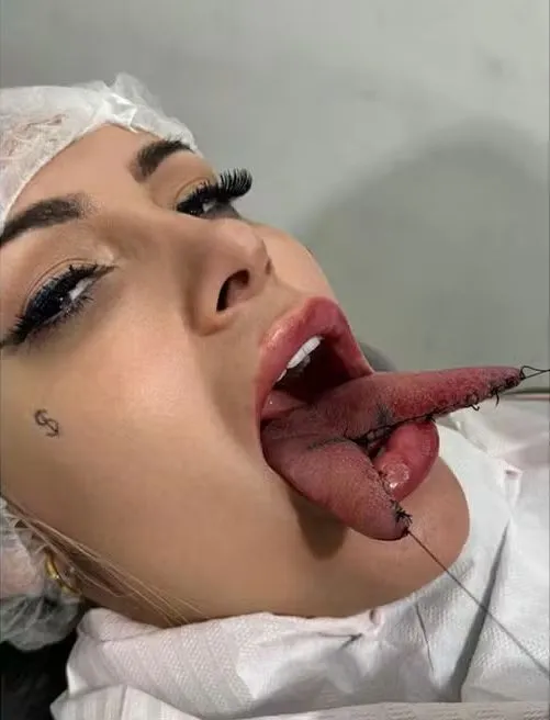 Imagem ilustrativa da imagem Língua de cobra? Andressa Urach faz procedimento em busca de prazer