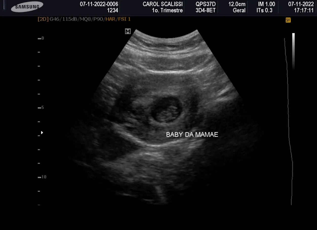 Imagem ilustrativa da imagem Ex-BBB baiana revela que sofreu aborto e choca web