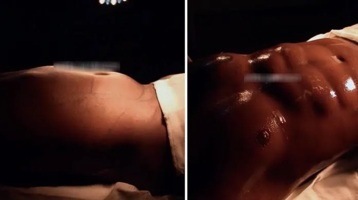 Reultado da Lipo HD do ex-BBB