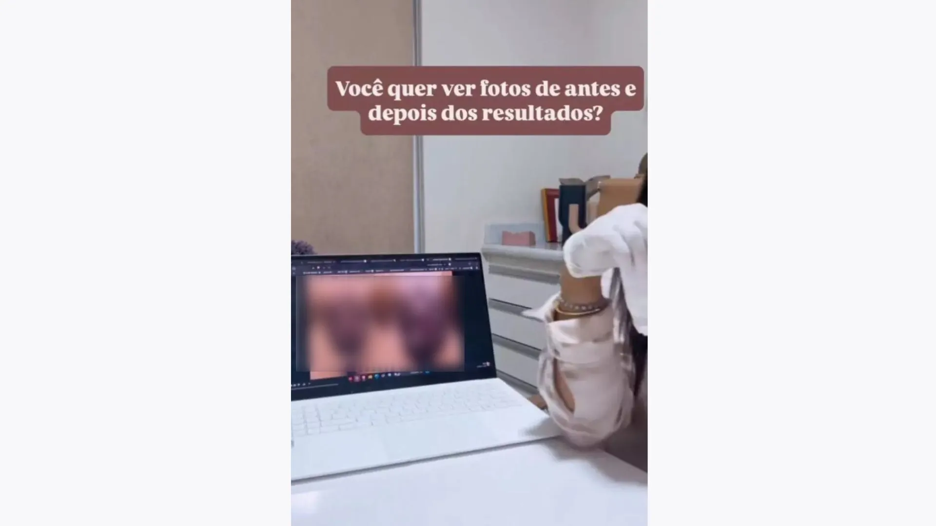 Imagem ilustrativa da imagem Mãe de ex-BBB choca a web ao postar antes e depois de cirurgia na ppk