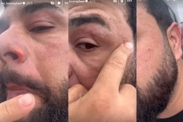 Imagem ilustrativa da imagem Veja: cantor Léo mostra como ficou o rosto após jato de fogo