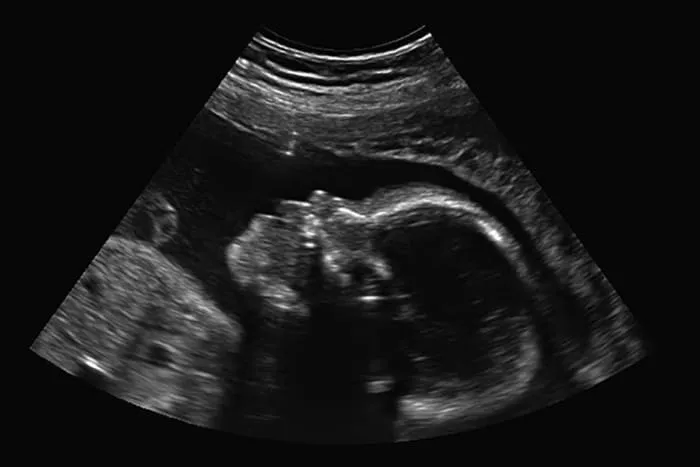 Imagem ilustrativa da imagem Jovem asfixia, joga bebê no lixo e grava aborto