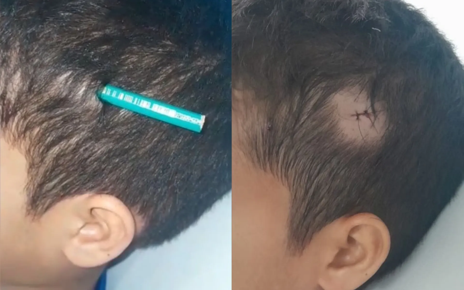Menino já vinha sofrendo agressões desse colega