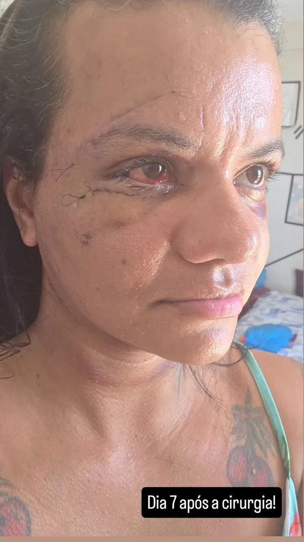 Imagem ilustrativa da imagem Mulher que levou 61 socos mostra como ficou o rosto após cirurgia