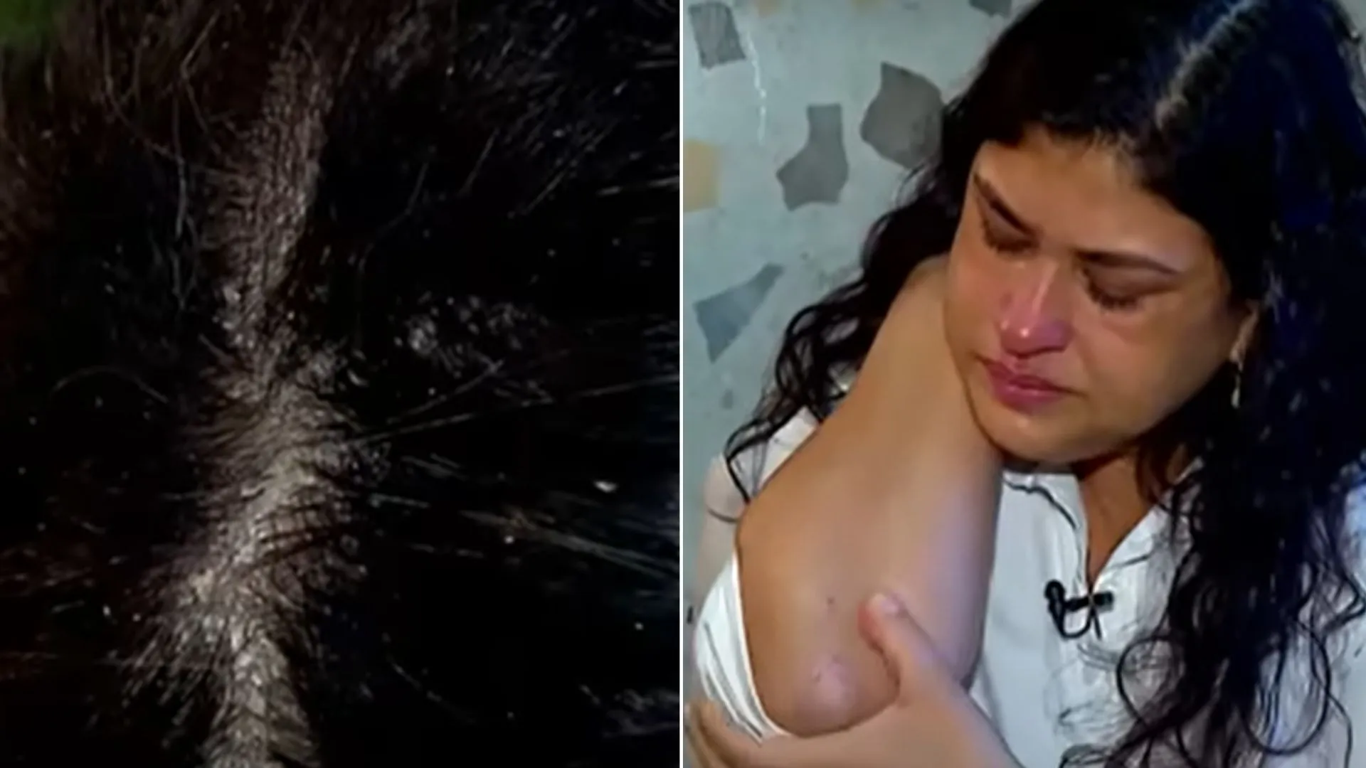 Ex-mulher de Manoel Gomes teve queda de cabelo e manchas na pele por crises de ansiedade