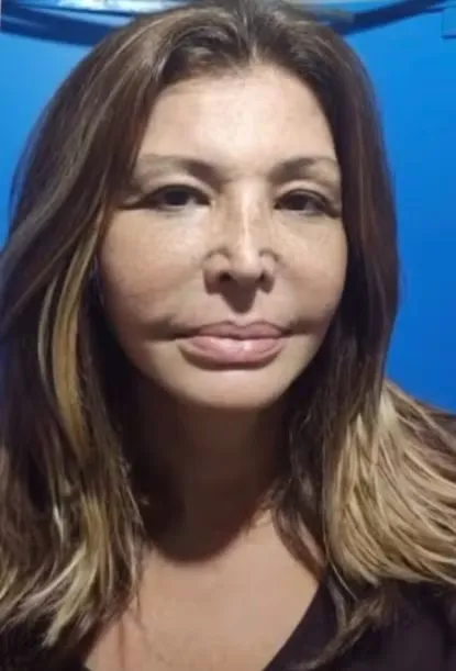 Resultado dos procedimentos